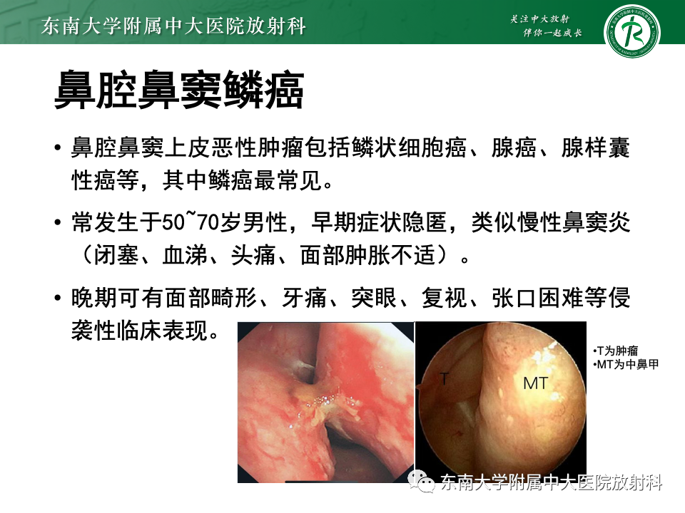 影像PPT - 【PPT】鼻腔鼻窦内翻性乳头状瘤-27