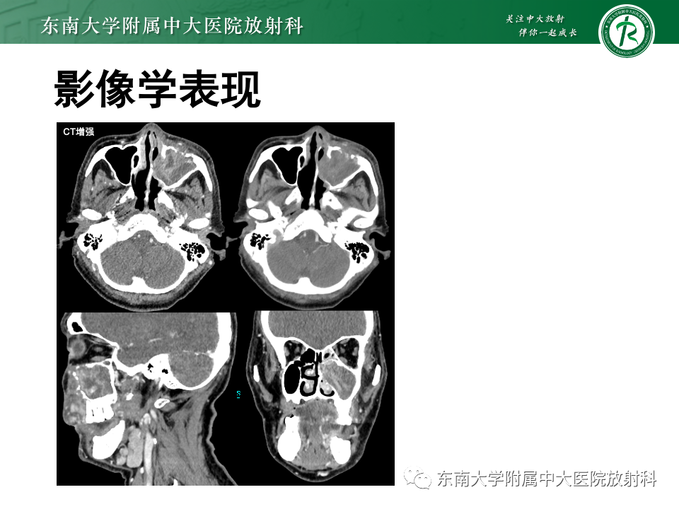 影像PPT - 【PPT】鼻腔鼻窦内翻性乳头状瘤-29
