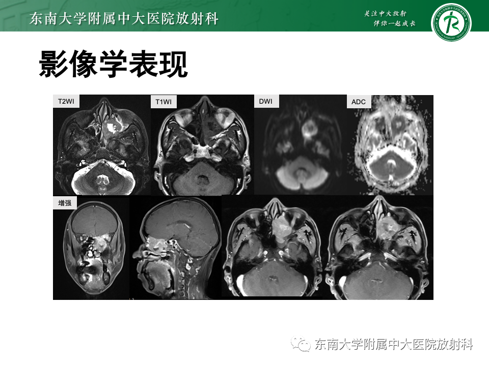 影像PPT - 【PPT】鼻腔鼻窦内翻性乳头状瘤-33