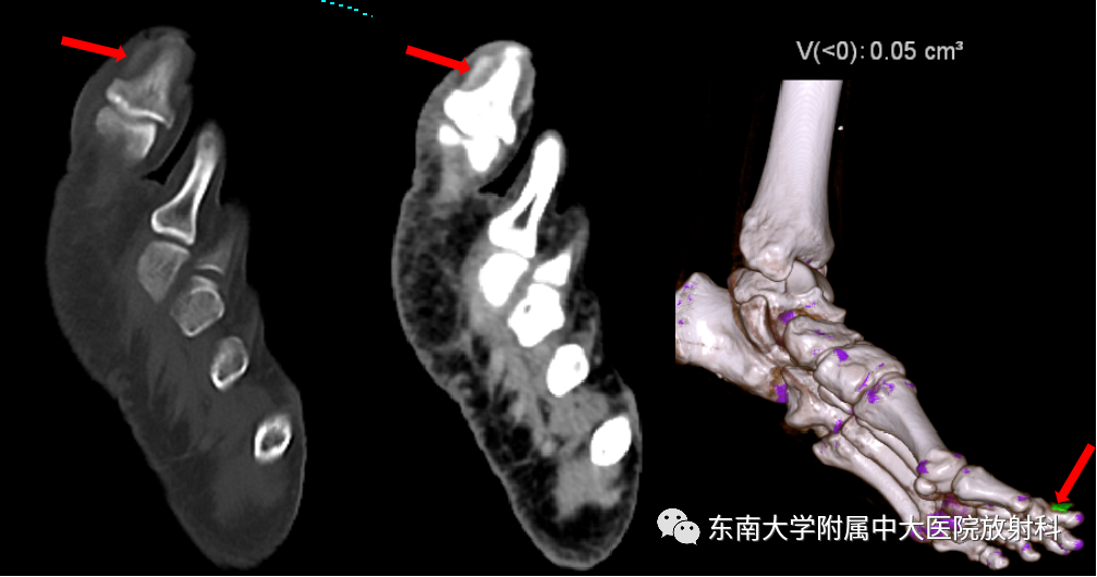影像PPT - 【PPT】痛风的影像学评估-1 影像PPT - 【PPT】痛风的影像学评估-1