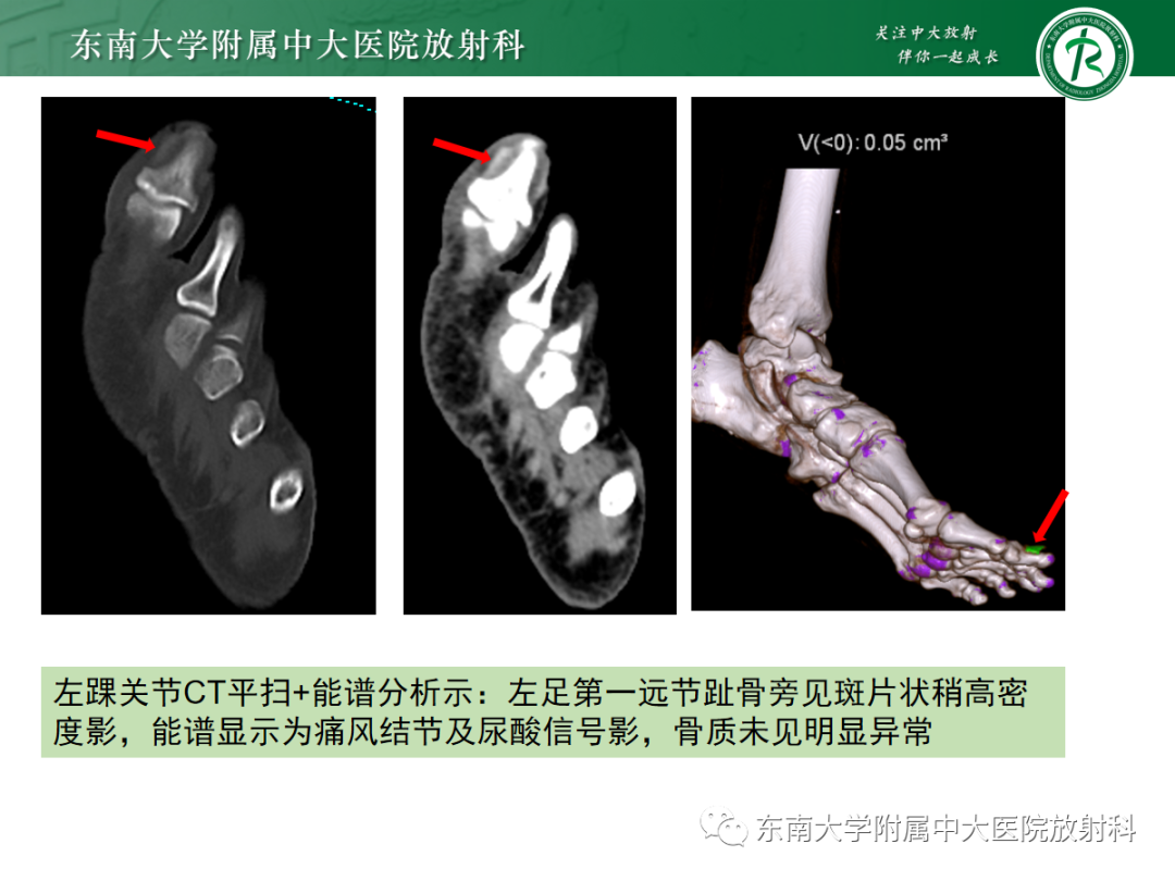 影像PPT - 【PPT】痛风的影像学评估-2 影像PPT - 【PPT】痛风的影像学评估-2