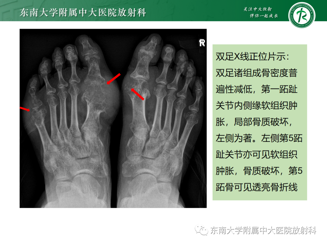 影像PPT - 【PPT】痛风的影像学评估-18 影像PPT - 【PPT】痛风的影像学评估-18
