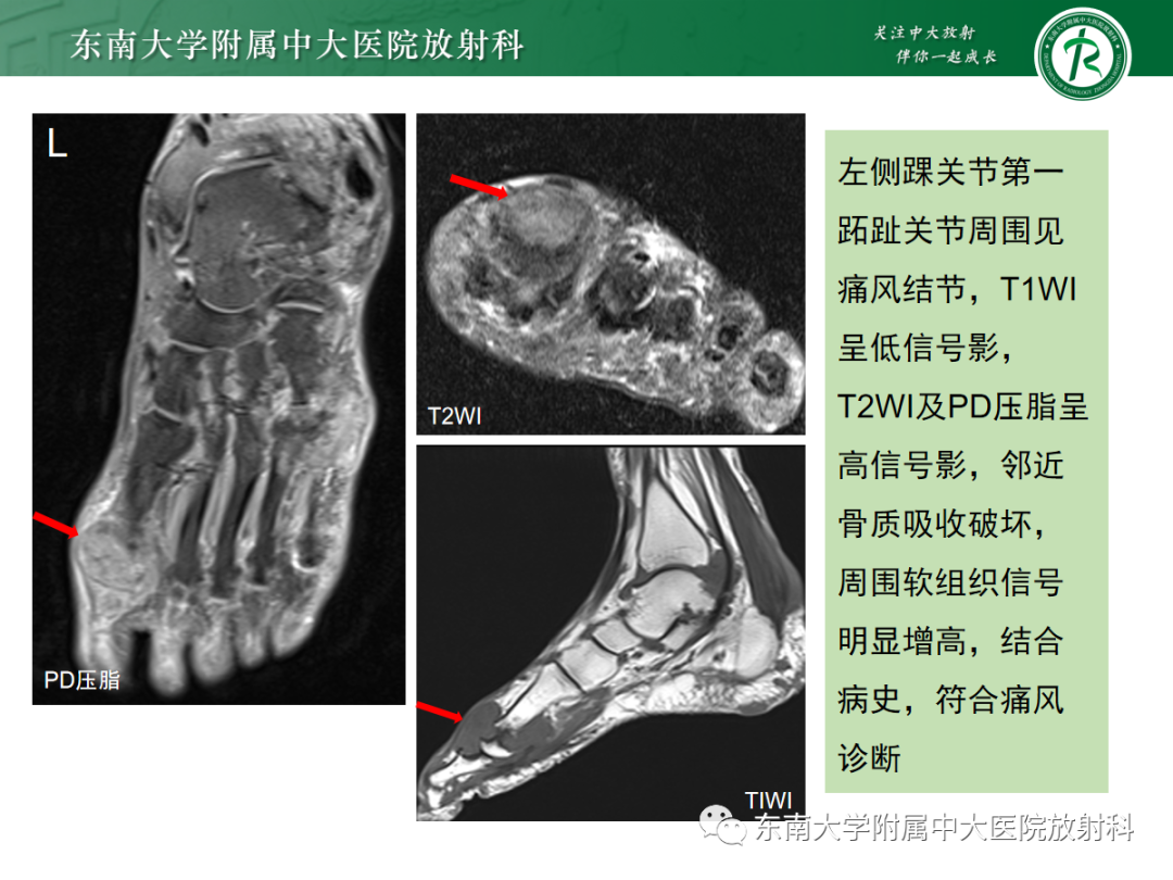 影像PPT - 【PPT】痛风的影像学评估-21 影像PPT - 【PPT】痛风的影像学评估-21