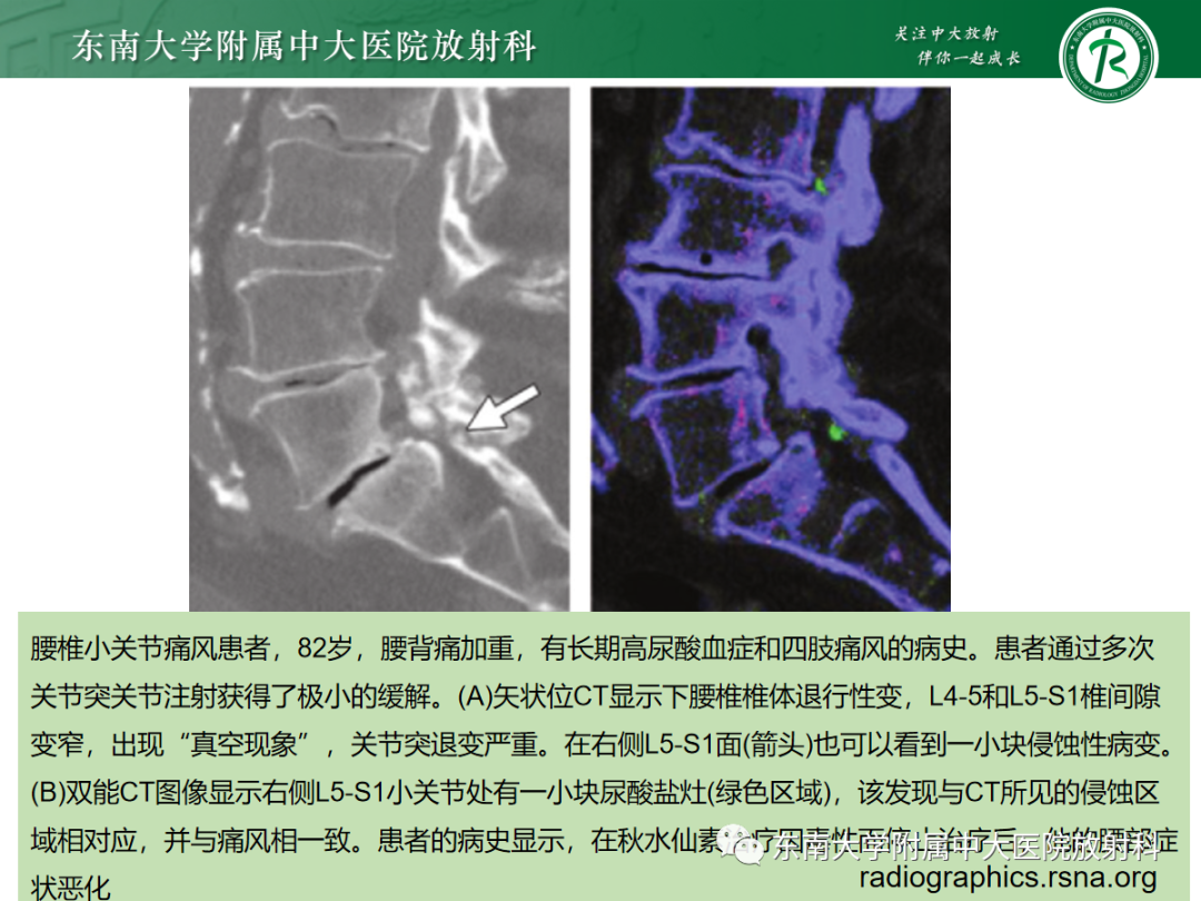 影像PPT - 【PPT】痛风的影像学评估-24 影像PPT - 【PPT】痛风的影像学评估-24