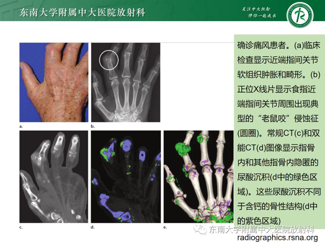 影像PPT - 【PPT】痛风的影像学评估-23 影像PPT - 【PPT】痛风的影像学评估-23