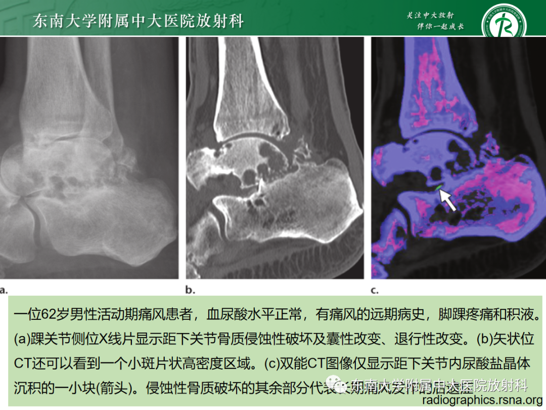 影像PPT - 【PPT】痛风的影像学评估-25 影像PPT - 【PPT】痛风的影像学评估-25
