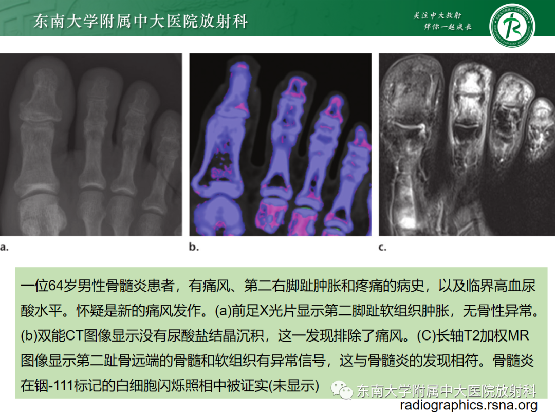 影像PPT - 【PPT】痛风的影像学评估-26 影像PPT - 【PPT】痛风的影像学评估-26