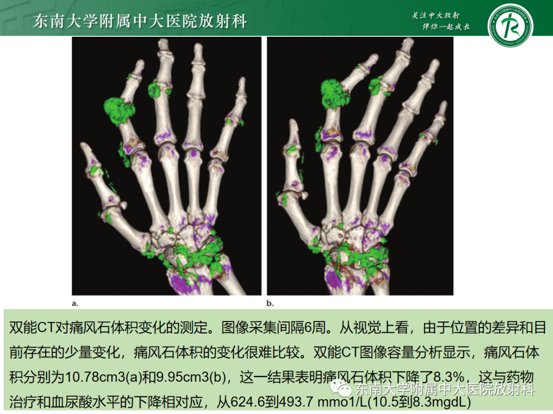 影像PPT - 【PPT】痛风的影像学评估-28 影像PPT - 【PPT】痛风的影像学评估-28