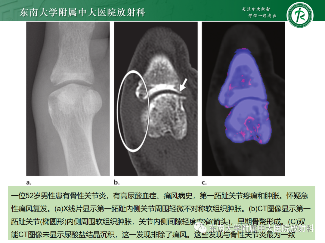影像PPT - 【PPT】痛风的影像学评估-27 影像PPT - 【PPT】痛风的影像学评估-27