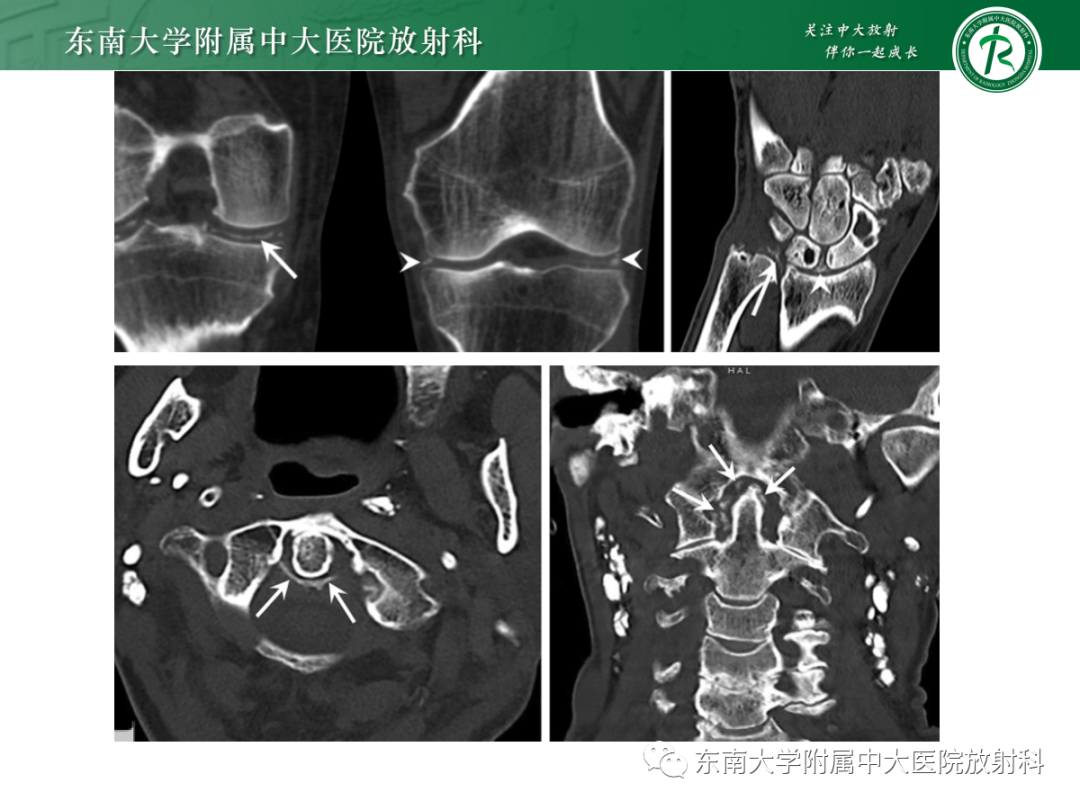 影像PPT - 【PPT】痛风的影像学评估-34 影像PPT - 【PPT】痛风的影像学评估-34