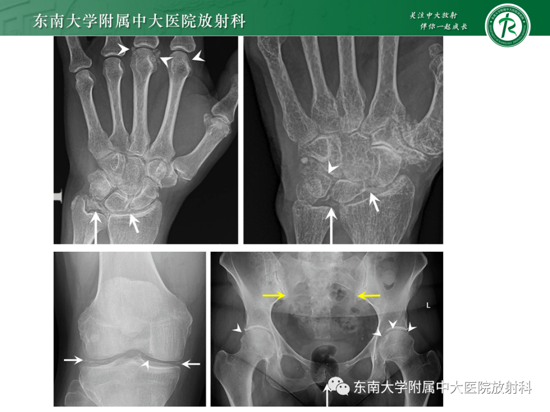 影像PPT - 【PPT】痛风的影像学评估-33 影像PPT - 【PPT】痛风的影像学评估-33
