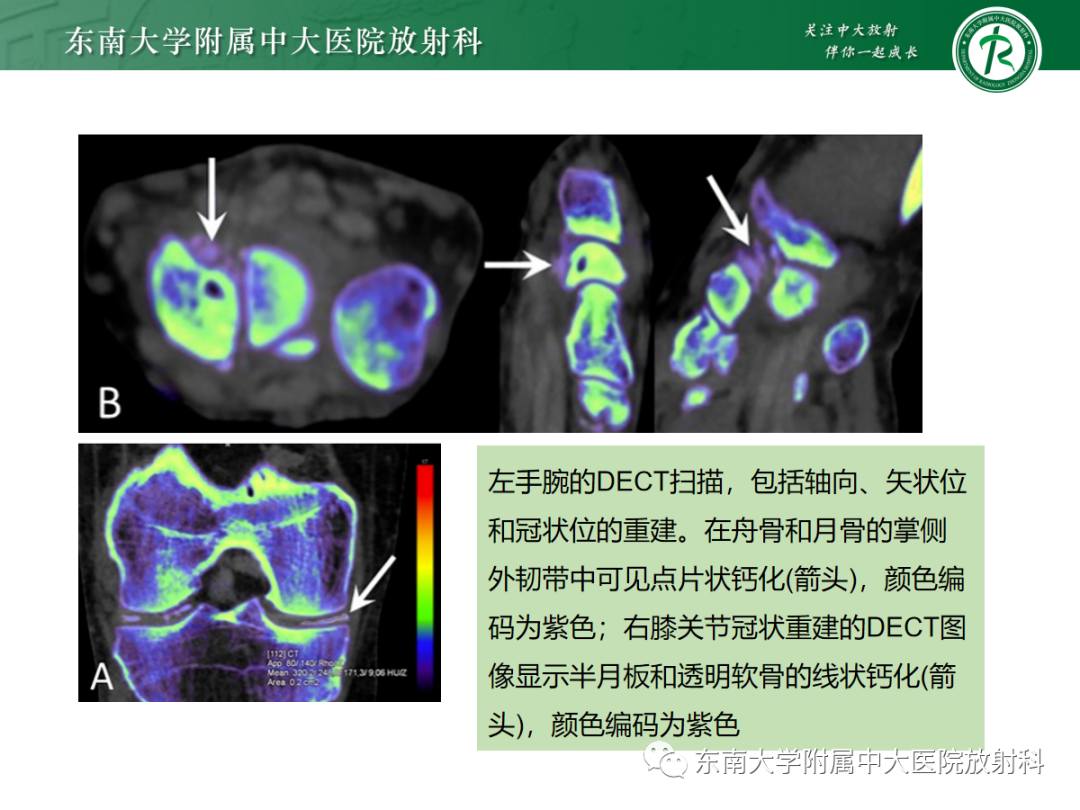 影像PPT - 【PPT】痛风的影像学评估-35 影像PPT - 【PPT】痛风的影像学评估-35