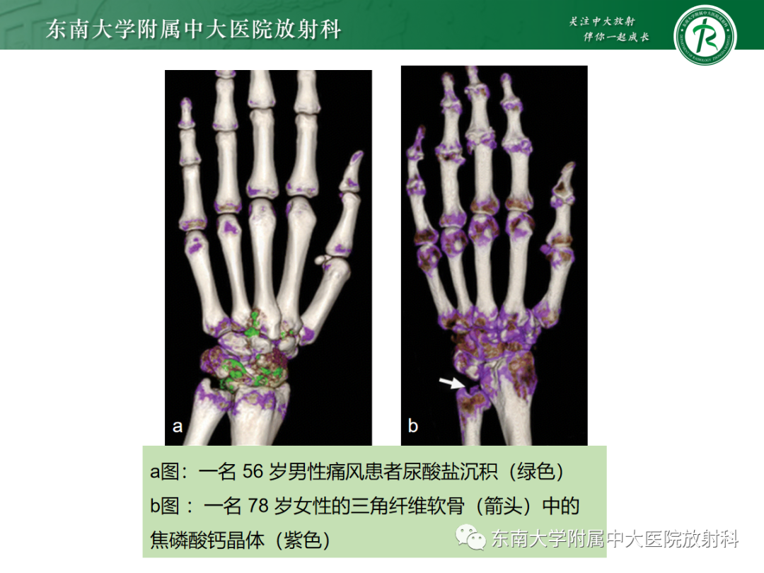 影像PPT - 【PPT】痛风的影像学评估-36 影像PPT - 【PPT】痛风的影像学评估-36