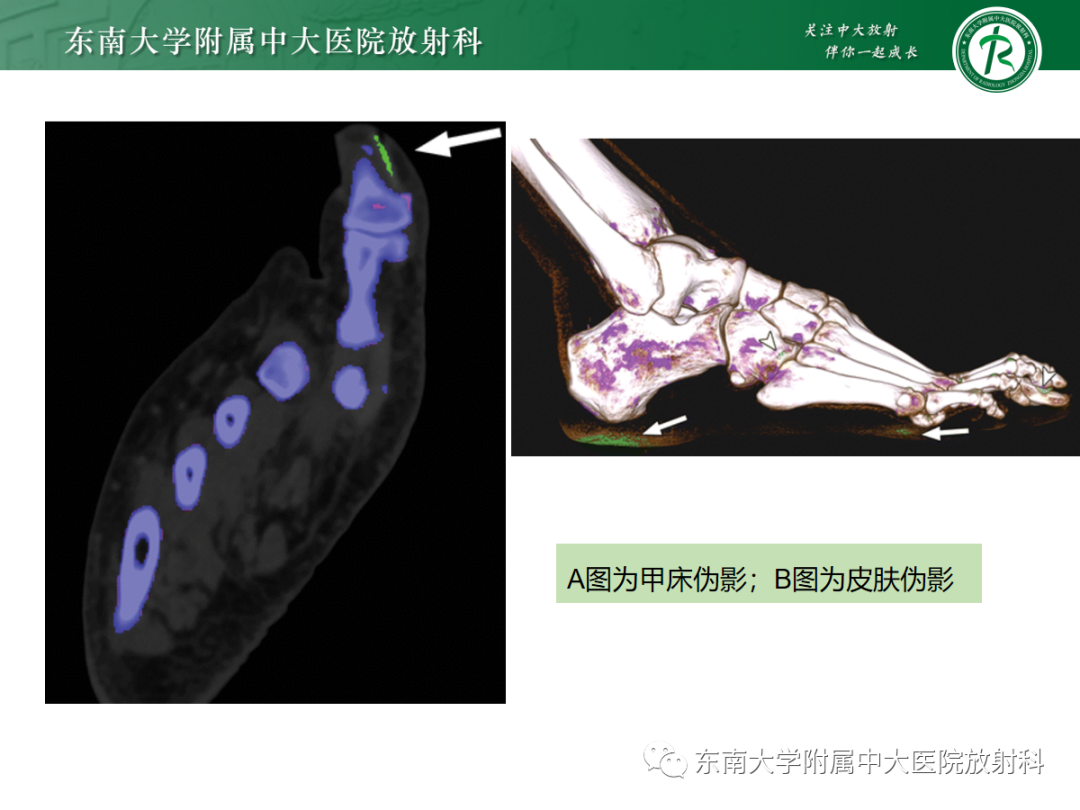 影像PPT - 【PPT】痛风的影像学评估-30 影像PPT - 【PPT】痛风的影像学评估-30
