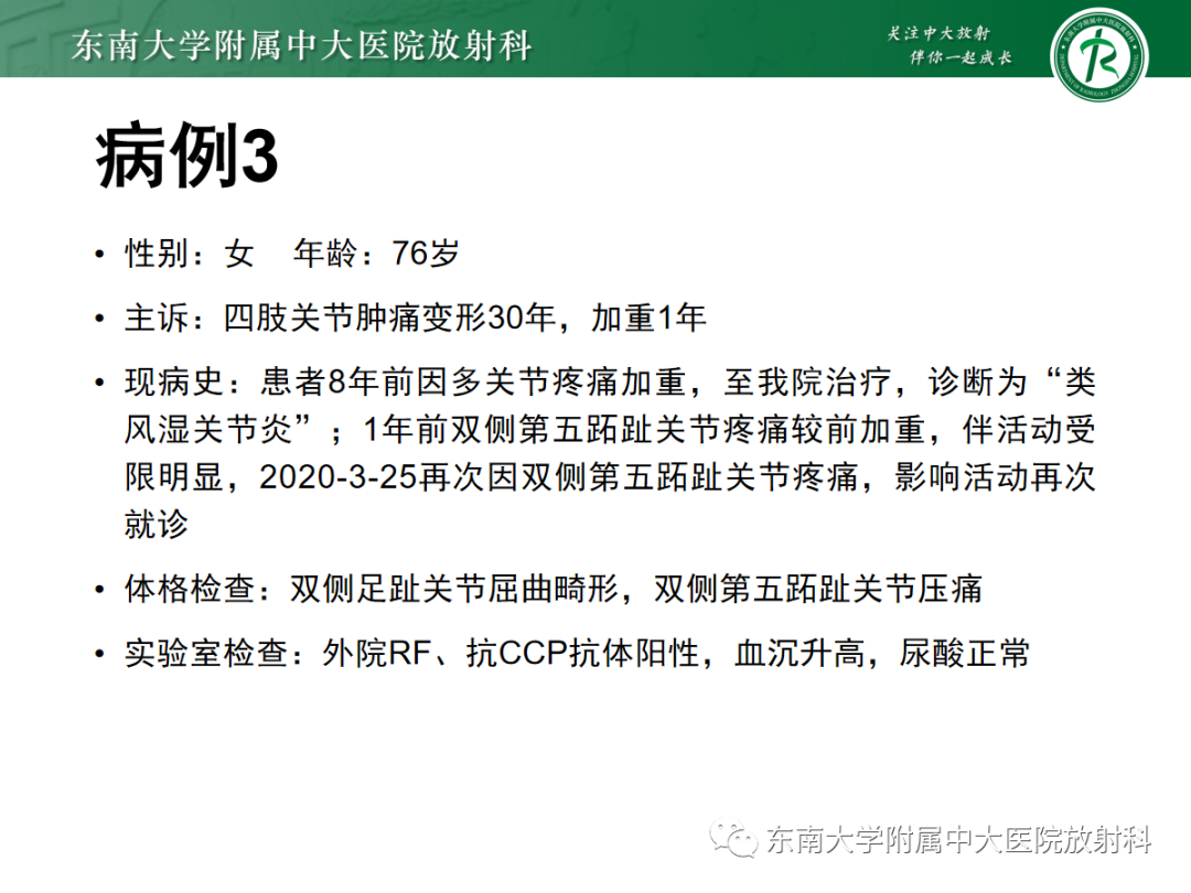 影像PPT - 【PPT】痛风的影像学评估-39 影像PPT - 【PPT】痛风的影像学评估-39