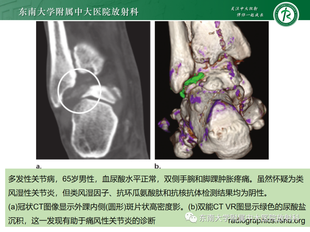 影像PPT - 【PPT】痛风的影像学评估-41 影像PPT - 【PPT】痛风的影像学评估-41