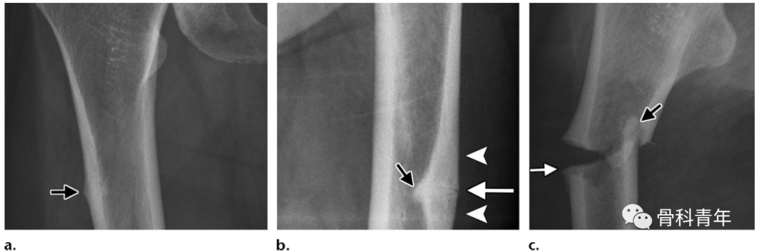 影像PPT - 非典型股骨骨折(Atypical Femur Fractures)的诊断标准与影像表现-9 影像PPT - 非典型股骨骨折(Atypical Femur Fractures)的诊断标准与影像表现-9