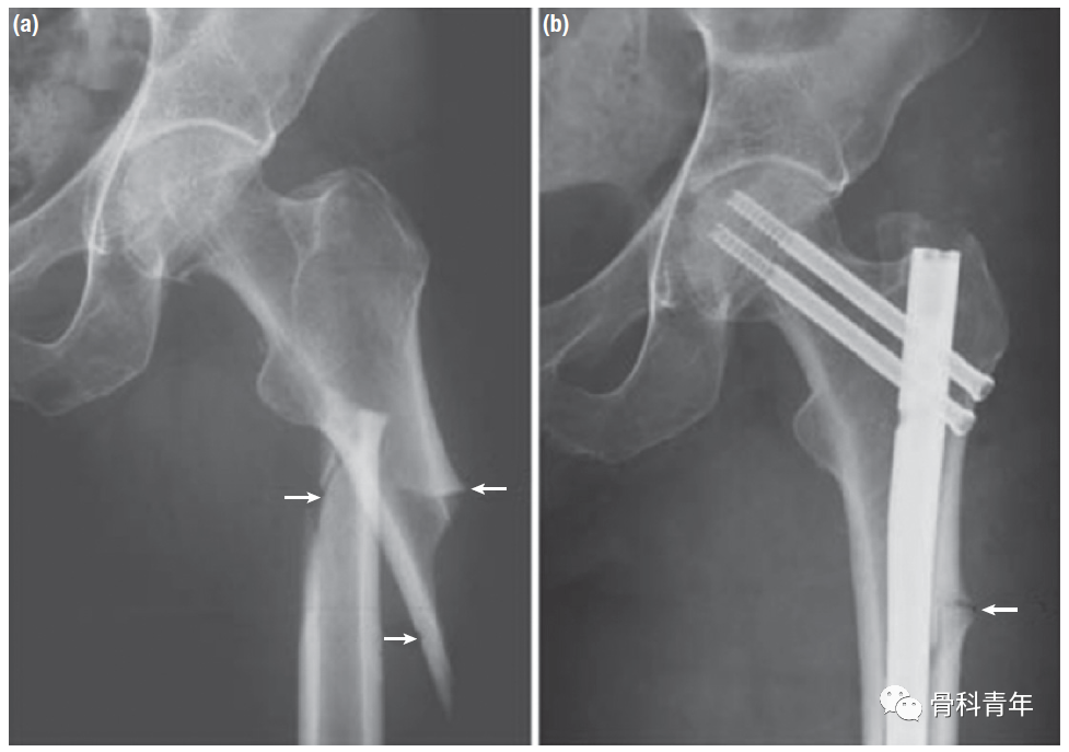 影像PPT - 非典型股骨骨折(Atypical Femur Fractures)的诊断标准与影像表现-10 影像PPT - 非典型股骨骨折(Atypical Femur Fractures)的诊断标准与影像表现-10
