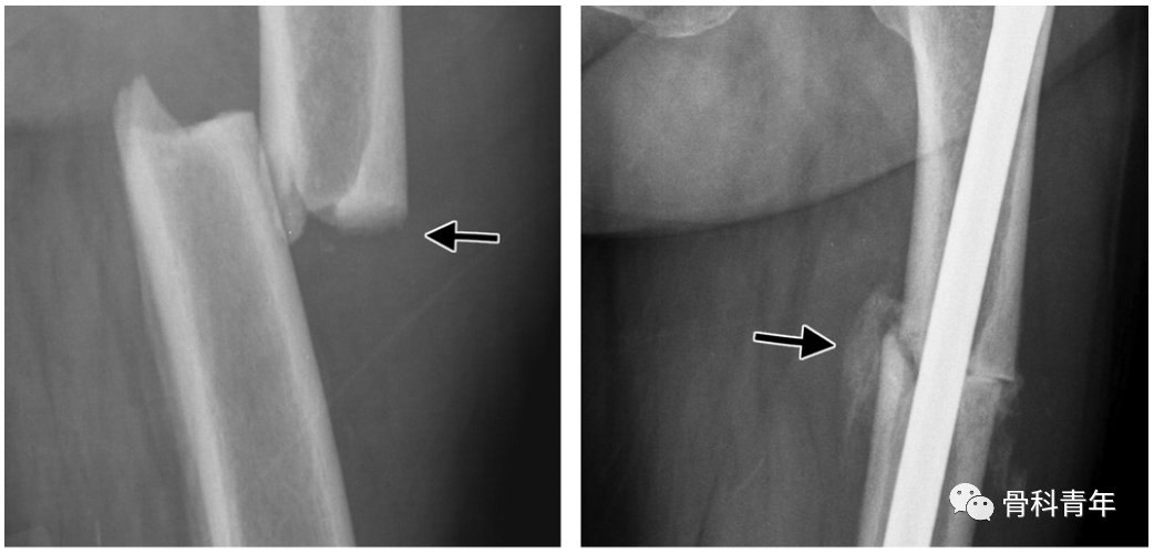 影像PPT - 非典型股骨骨折(Atypical Femur Fractures)的诊断标准与影像表现-11 影像PPT - 非典型股骨骨折(Atypical Femur Fractures)的诊断标准与影像表现-11