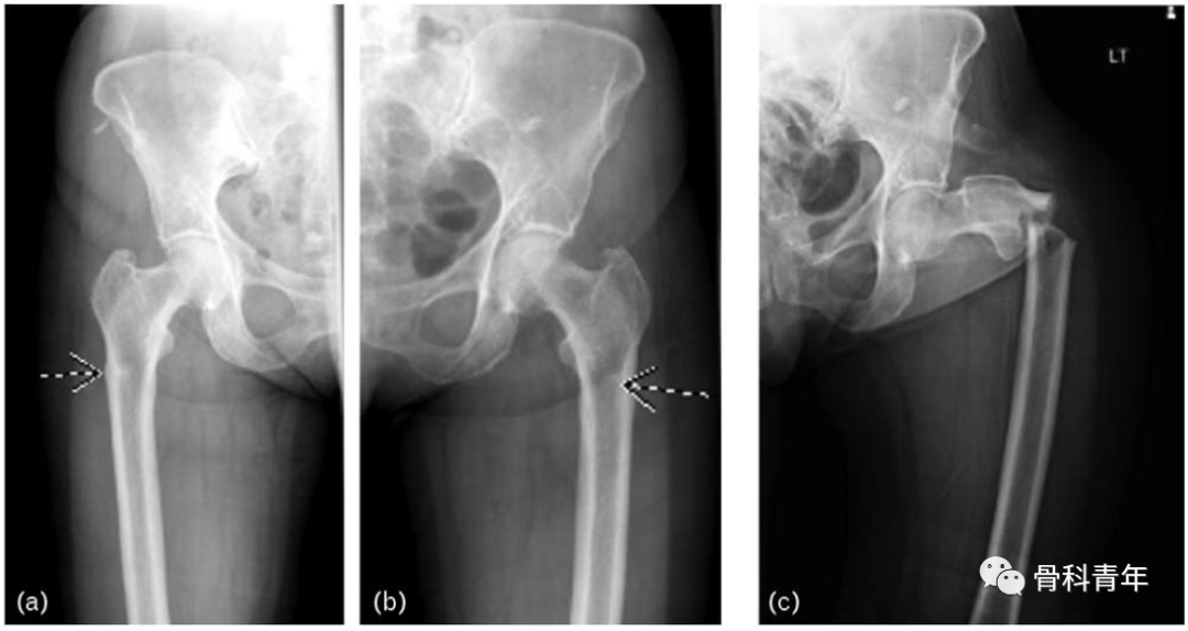 影像PPT - 非典型股骨骨折(Atypical Femur Fractures)的诊断标准与影像表现-12 影像PPT - 非典型股骨骨折(Atypical Femur Fractures)的诊断标准与影像表现-12