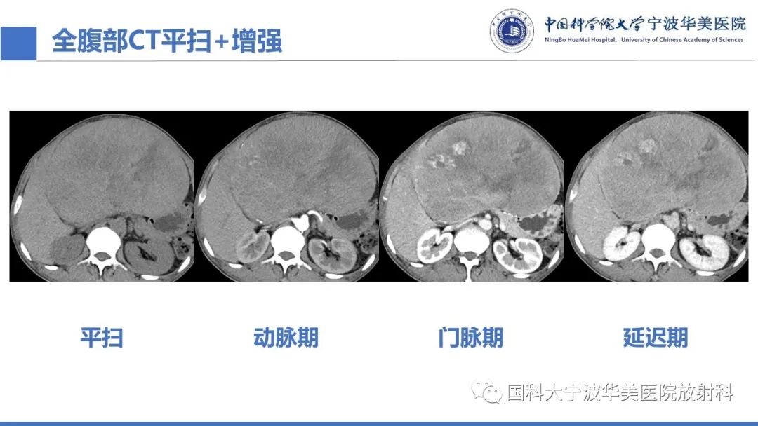影像PPT - 【PPT】原发性肝脏神经内分泌肿瘤-7