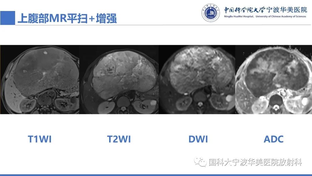 影像PPT - 【PPT】原发性肝脏神经内分泌肿瘤-8