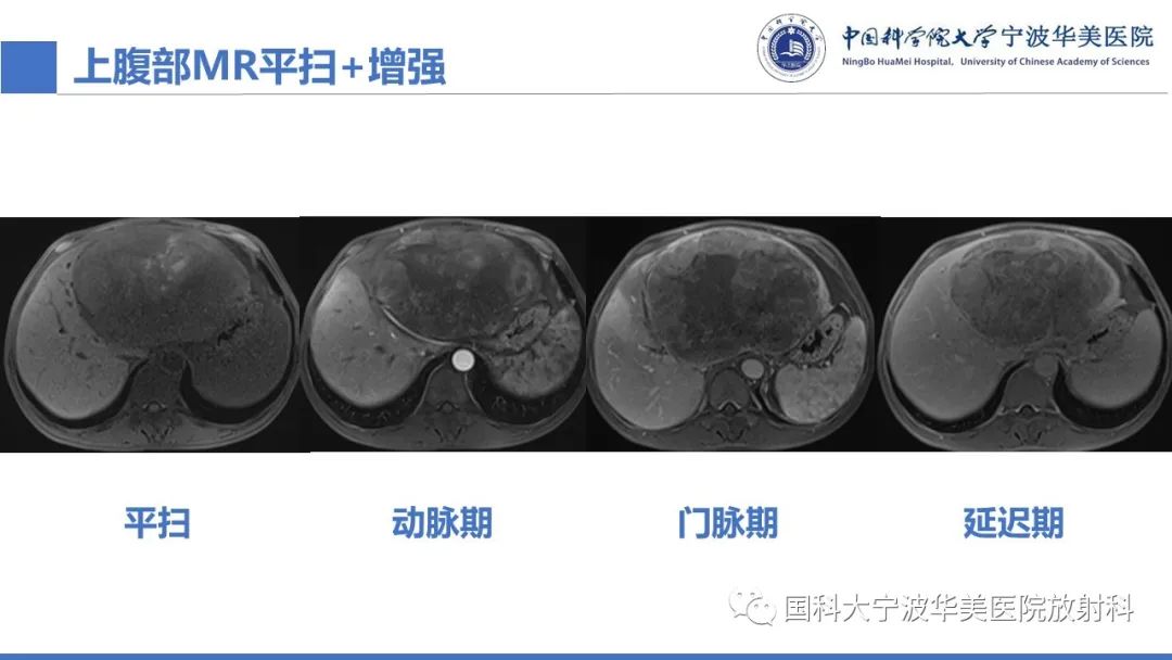 影像PPT - 【PPT】原发性肝脏神经内分泌肿瘤-9