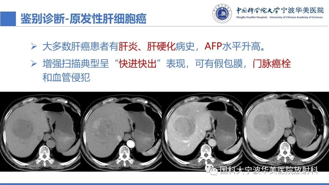 影像PPT - 【PPT】原发性肝脏神经内分泌肿瘤-27