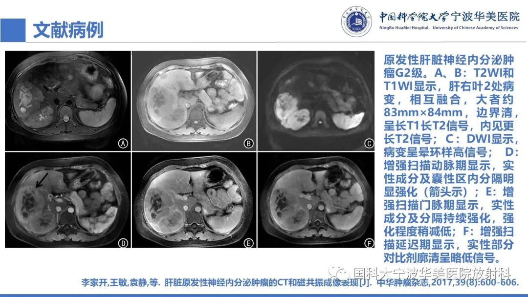 影像PPT - 【PPT】原发性肝脏神经内分泌肿瘤-26