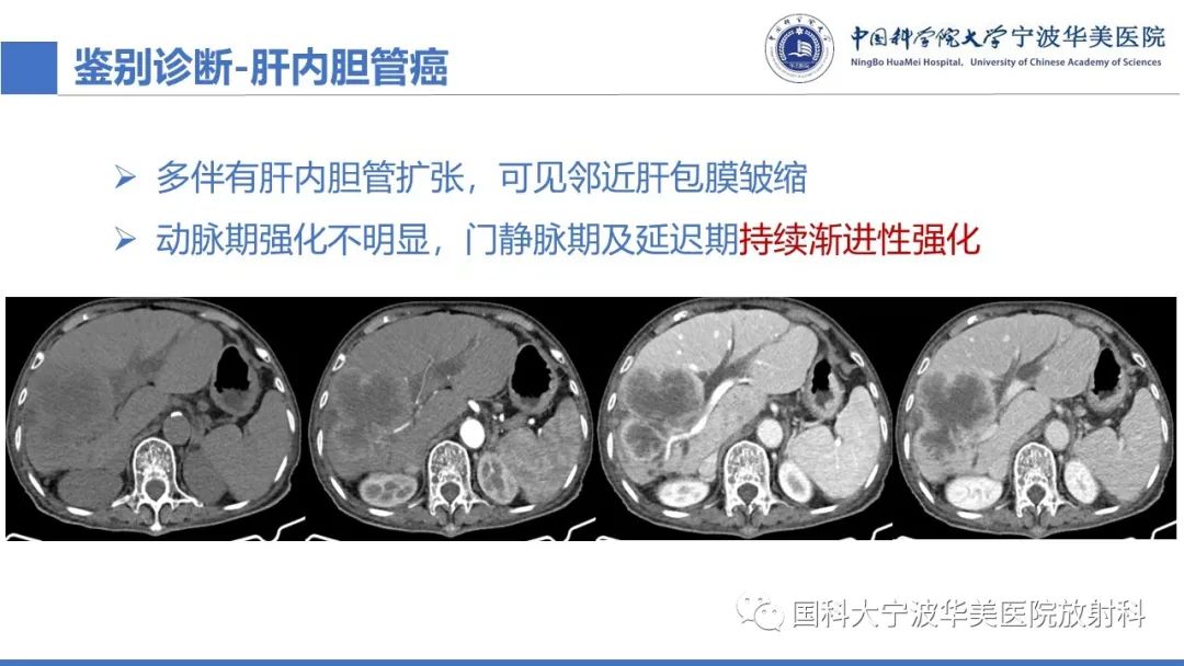 影像PPT - 【PPT】原发性肝脏神经内分泌肿瘤-28