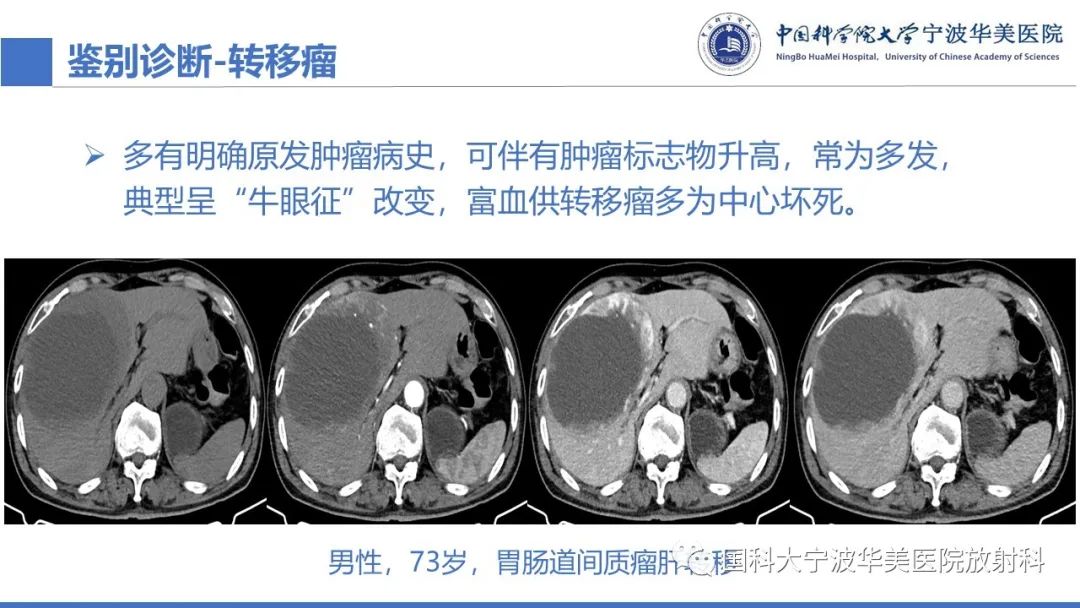 影像PPT - 【PPT】原发性肝脏神经内分泌肿瘤-29