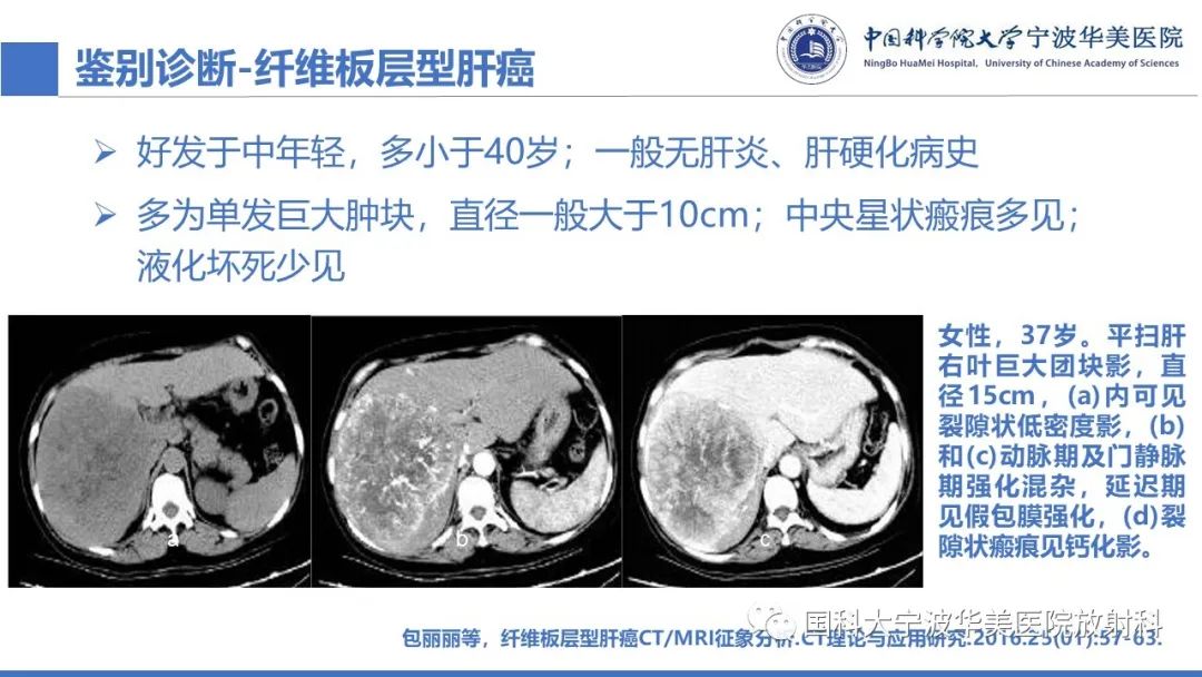 影像PPT - 【PPT】原发性肝脏神经内分泌肿瘤-30