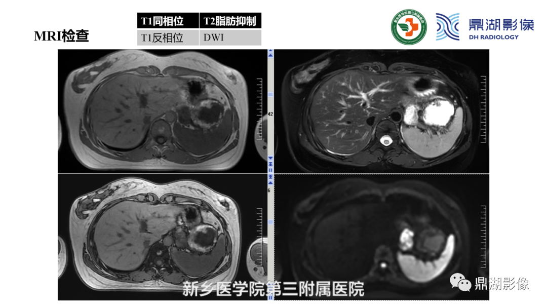 影像PPT - 【病例】胰腺实性假乳头状瘤1例CT及MR影像-6 影像PPT - 【病例】胰腺实性假乳头状瘤1例CT及MR影像-6