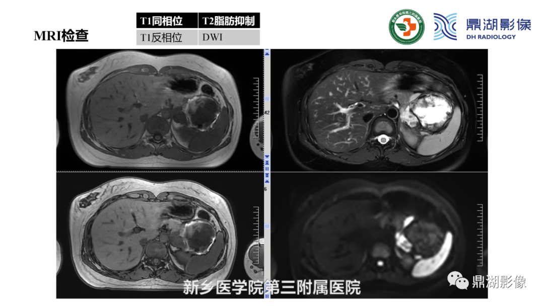 影像PPT - 【病例】胰腺实性假乳头状瘤1例CT及MR影像-7 影像PPT - 【病例】胰腺实性假乳头状瘤1例CT及MR影像-7