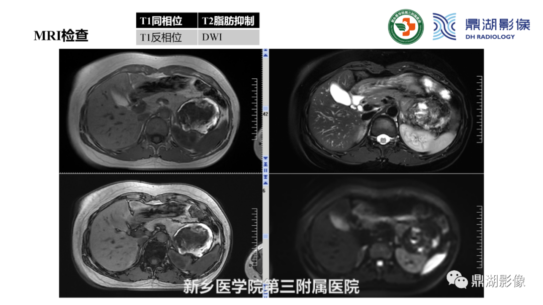 影像PPT - 【病例】胰腺实性假乳头状瘤1例CT及MR影像-8 影像PPT - 【病例】胰腺实性假乳头状瘤1例CT及MR影像-8