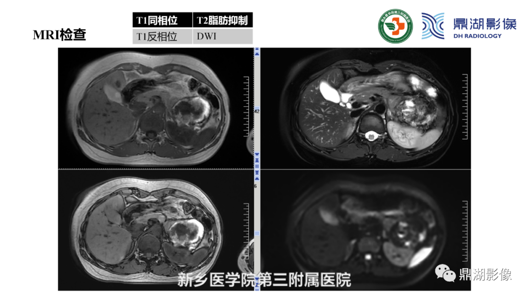 影像PPT - 【病例】胰腺实性假乳头状瘤1例CT及MR影像-9 影像PPT - 【病例】胰腺实性假乳头状瘤1例CT及MR影像-9