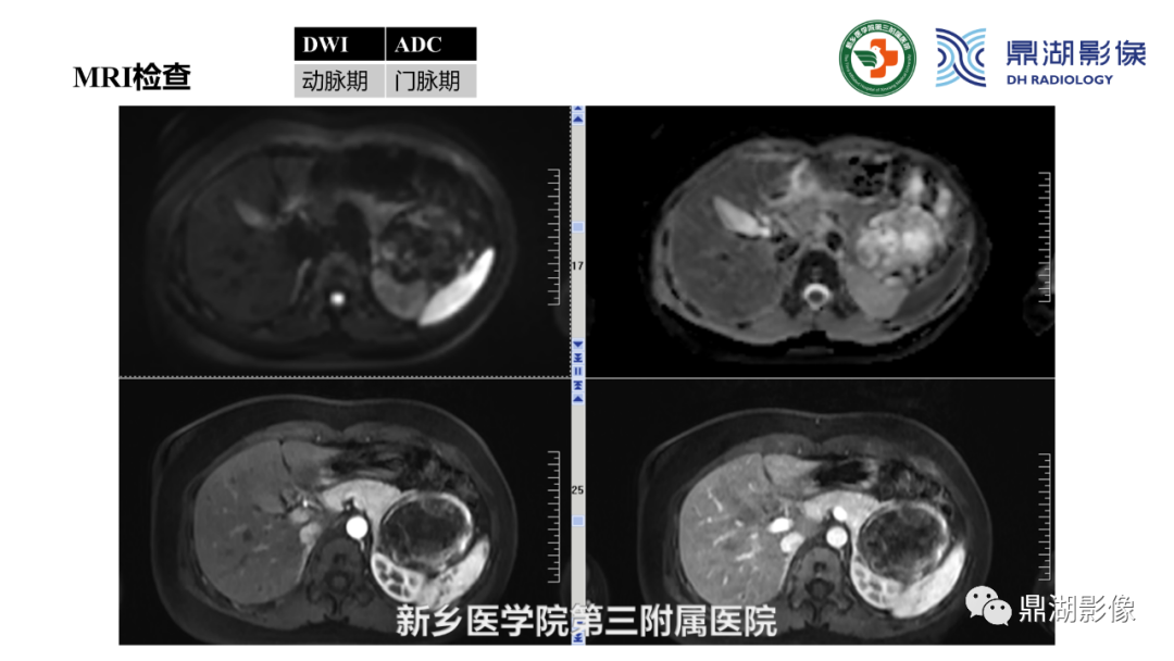 影像PPT - 【病例】胰腺实性假乳头状瘤1例CT及MR影像-12 影像PPT - 【病例】胰腺实性假乳头状瘤1例CT及MR影像-12