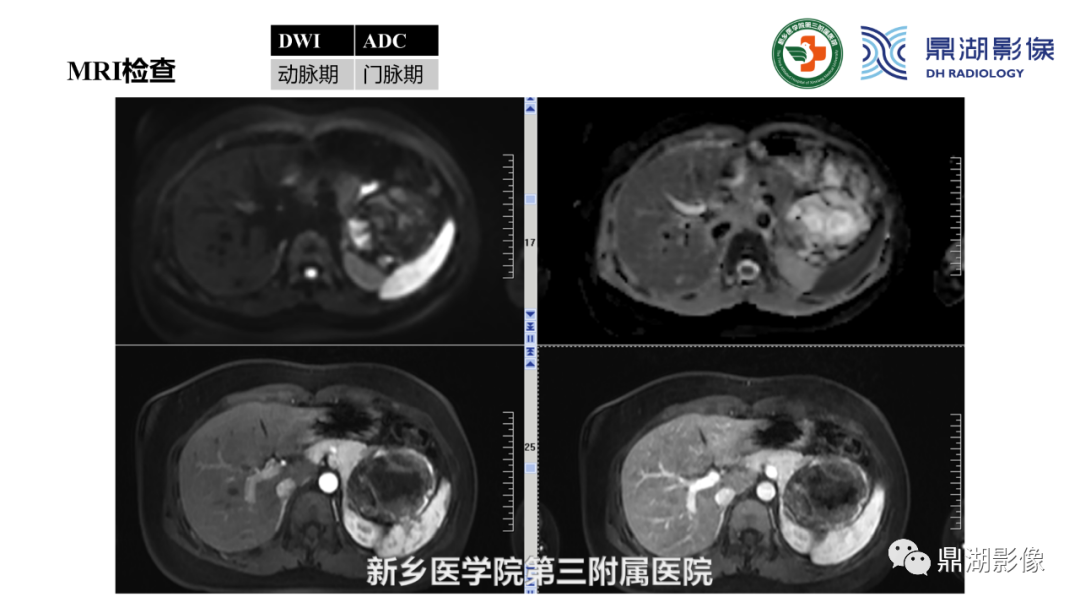 影像PPT - 【病例】胰腺实性假乳头状瘤1例CT及MR影像-11 影像PPT - 【病例】胰腺实性假乳头状瘤1例CT及MR影像-11