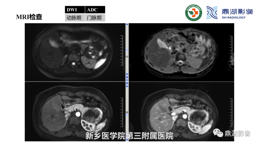 影像PPT - 【病例】胰腺实性假乳头状瘤1例CT及MR影像-13 影像PPT - 【病例】胰腺实性假乳头状瘤1例CT及MR影像-13