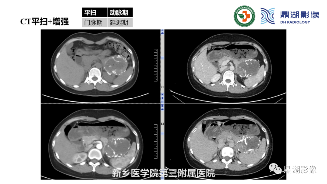 影像PPT - 【病例】胰腺实性假乳头状瘤1例CT及MR影像-14 影像PPT - 【病例】胰腺实性假乳头状瘤1例CT及MR影像-14