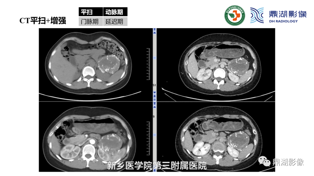 影像PPT - 【病例】胰腺实性假乳头状瘤1例CT及MR影像-15 影像PPT - 【病例】胰腺实性假乳头状瘤1例CT及MR影像-15