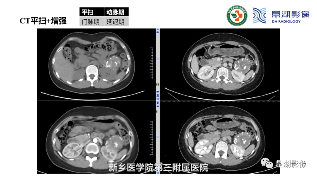 影像PPT - 【病例】胰腺实性假乳头状瘤1例CT及MR影像-16 影像PPT - 【病例】胰腺实性假乳头状瘤1例CT及MR影像-16