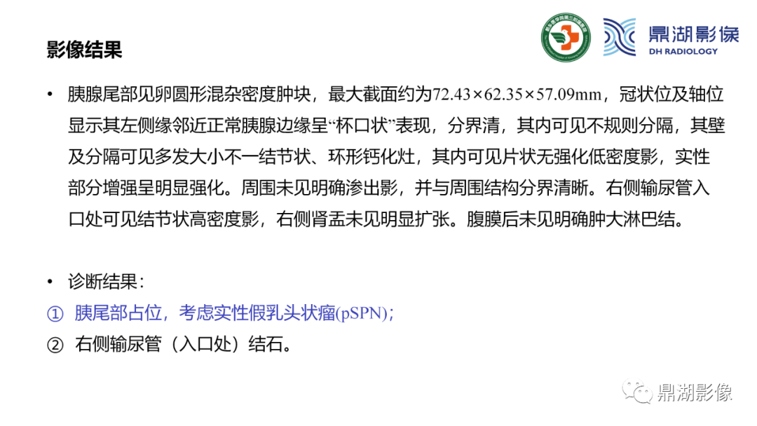 影像PPT - 【病例】胰腺实性假乳头状瘤1例CT及MR影像-19 影像PPT - 【病例】胰腺实性假乳头状瘤1例CT及MR影像-19