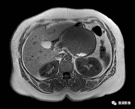 影像PPT - 【病例】胰腺实性假乳头状瘤1例CT及MR影像-31 影像PPT - 【病例】胰腺实性假乳头状瘤1例CT及MR影像-31