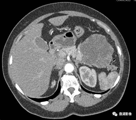 影像PPT - 【病例】胰腺实性假乳头状瘤1例CT及MR影像-33 影像PPT - 【病例】胰腺实性假乳头状瘤1例CT及MR影像-33