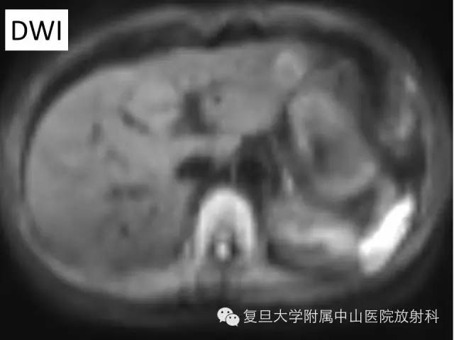 影像PPT - 【病例】肝脏孤立性坏死结节1例MR影像-2 影像PPT - 【病例】肝脏孤立性坏死结节1例MR影像-2