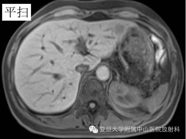 影像PPT - 【病例】肝脏孤立性坏死结节1例MR影像-3 影像PPT - 【病例】肝脏孤立性坏死结节1例MR影像-3