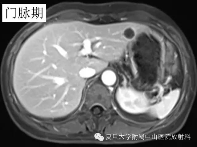 影像PPT - 【病例】肝脏孤立性坏死结节1例MR影像-5 影像PPT - 【病例】肝脏孤立性坏死结节1例MR影像-5