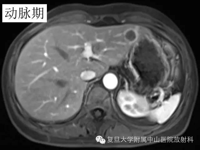 影像PPT - 【病例】肝脏孤立性坏死结节1例MR影像-4 影像PPT - 【病例】肝脏孤立性坏死结节1例MR影像-4