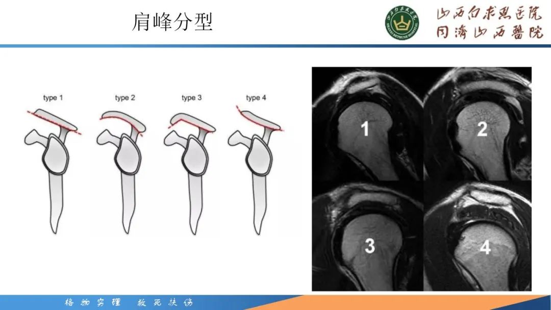 影像PPT - 【PPT】肩关节损伤的MRI表现-10